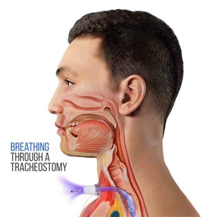 
Did Jean Claude Van Damme Have Tracheostomy For Throat Cancer? What Happened? 