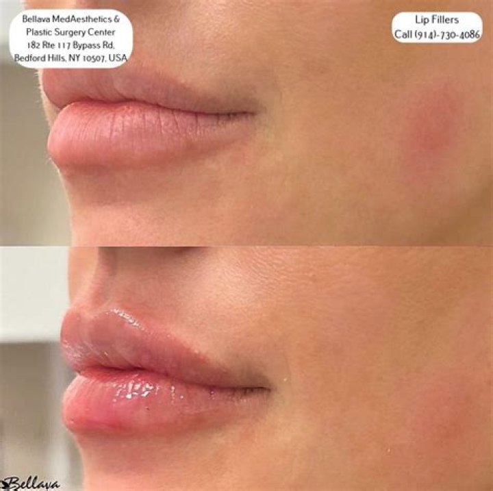 Has Aubrey Plaza Done Plastic Surgery? Fans Curious About Lip Filler And Nose Job